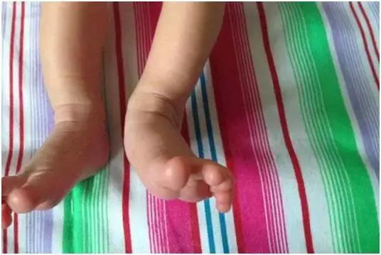 儿童足内外翻矫正训练,小儿足内外翻