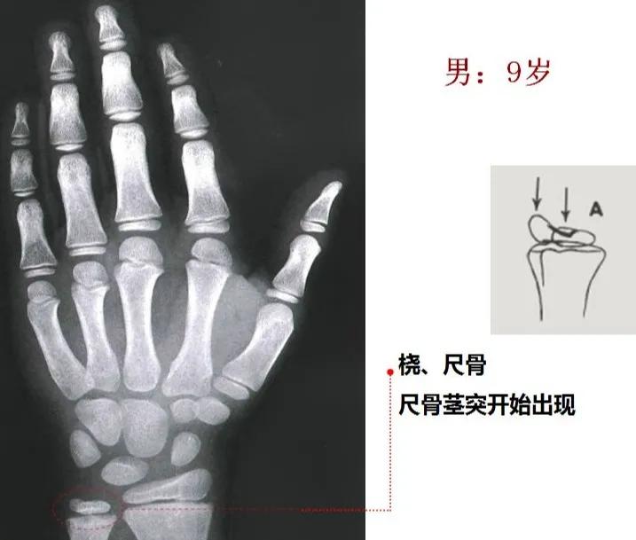 孩子个子高却跑不快,小孩个头不高