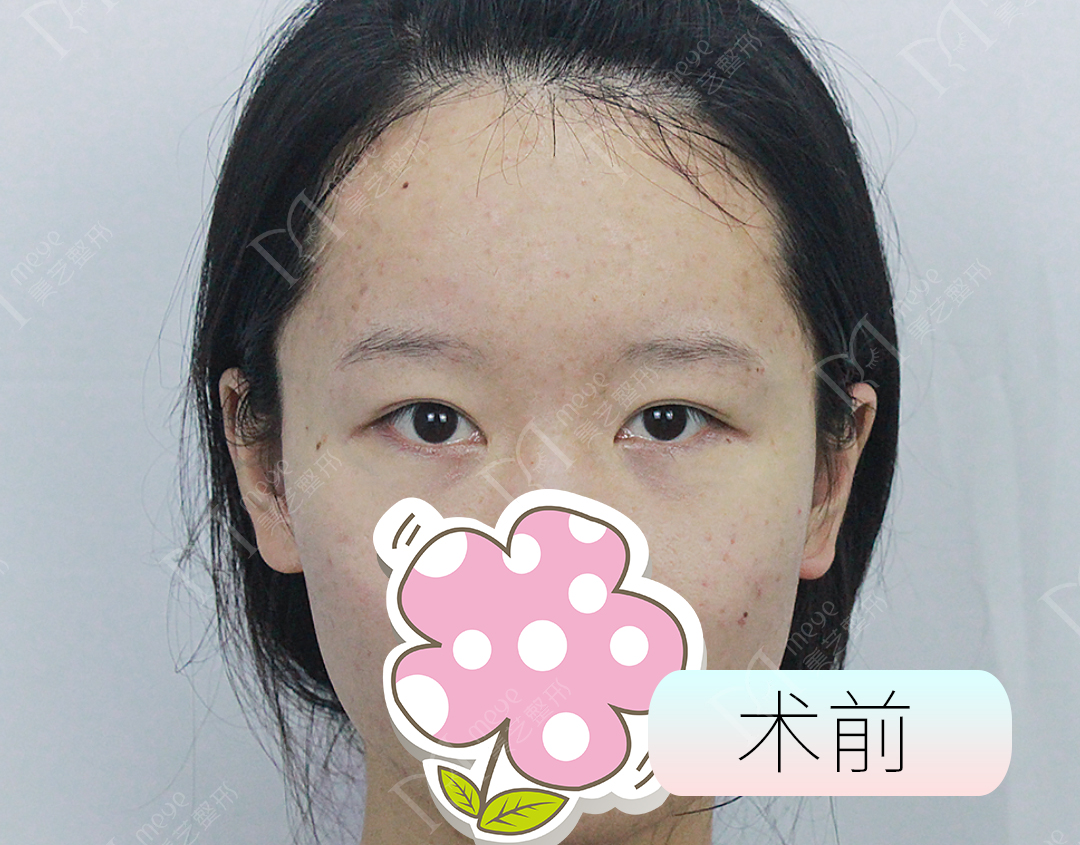 双眼皮失败了怎么修复好,双眼皮修复失败怎么解决