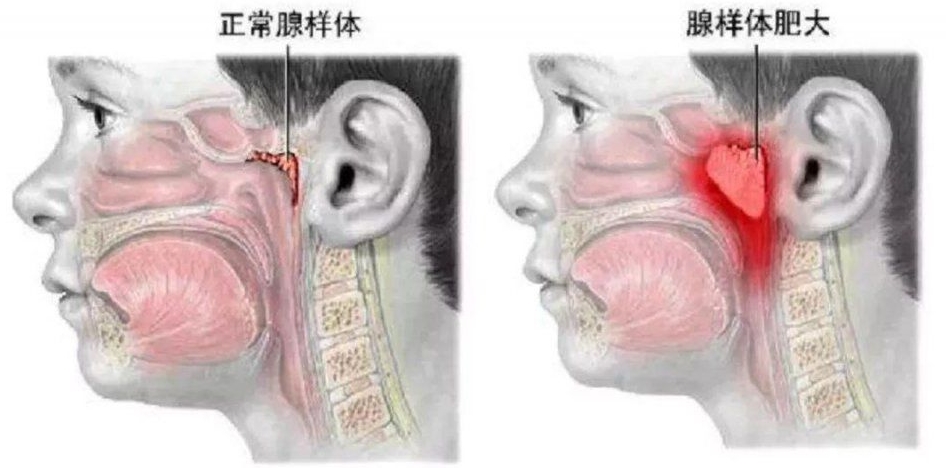 儿童腺样体肥大张口呼吸怎么矫正,小孩腺样体肥大怎么解决张嘴呼吸