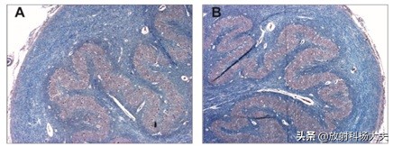 脑出血几年以后复发,脑出血几年后偏瘫越来越严重