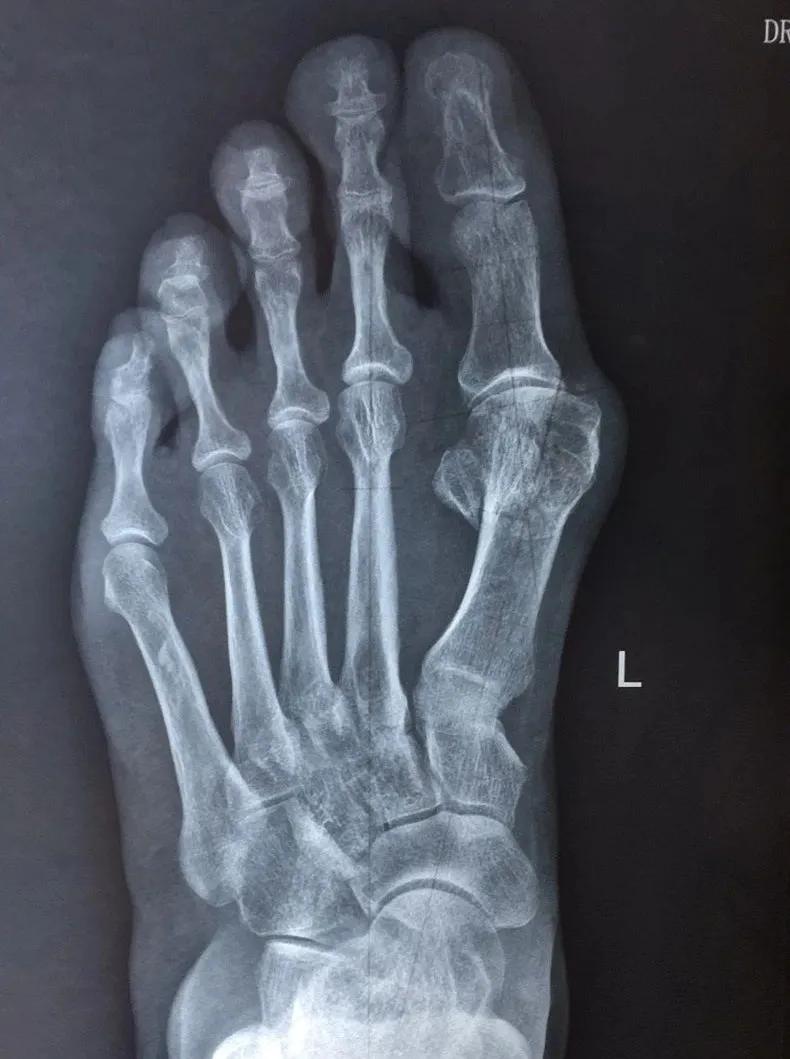 足底走路感觉骨头痛,足底痛是肾的原因吗