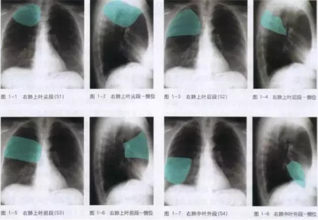 x线胸部解剖,胸部x线解读视频