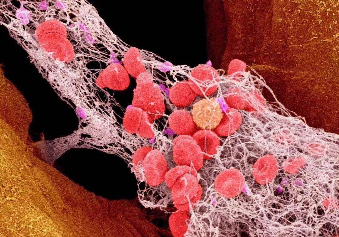 火鹰心脏支架怎么样,火鹰支架是第几代