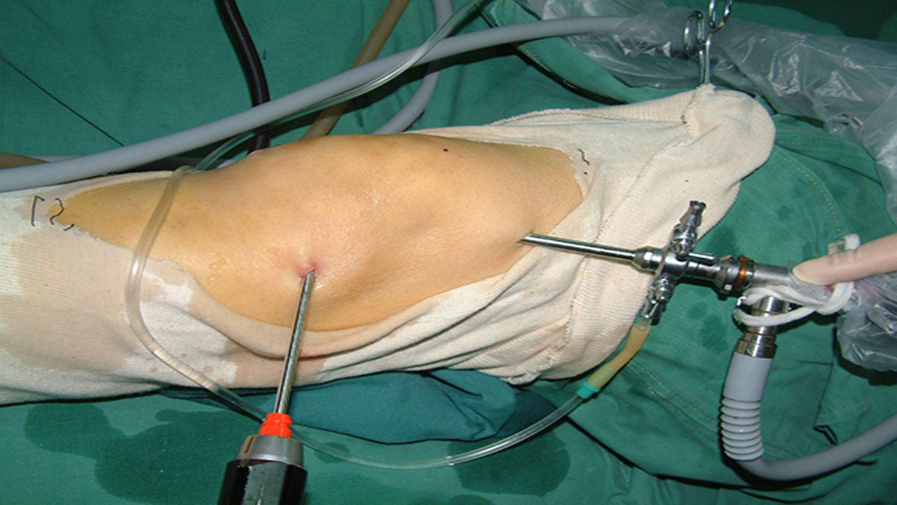 前叉和半月板术后多久可以负重,前叉跟半月板手术后多久练习走路