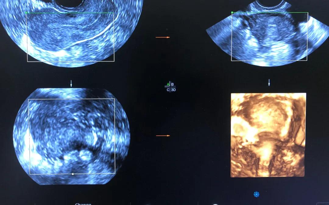 渭南市妇幼保健院四维单子,超声诊断弓形子宫