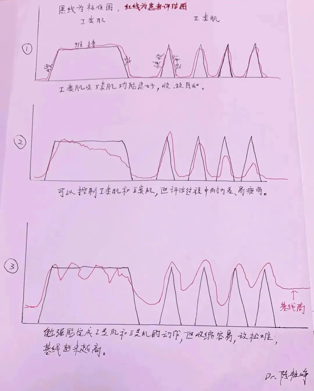产前自测盆底的正确方法,怎么自测盆底修复是否有效