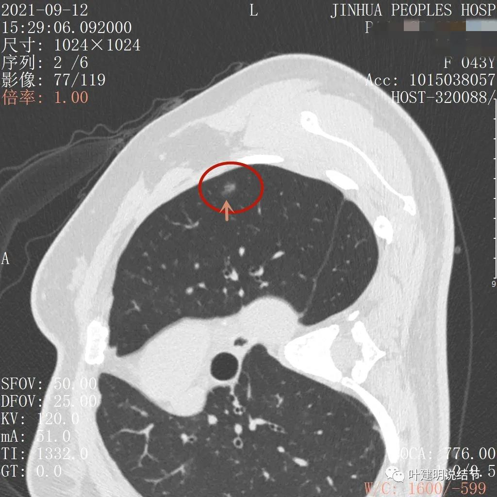 从活检怎么看是非小细胞癌,从病例谈辨证论治