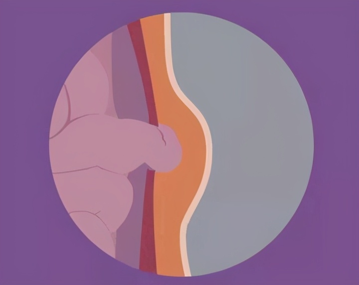 中医治疗腹股沟疝气,小肠疝气的治疗方法