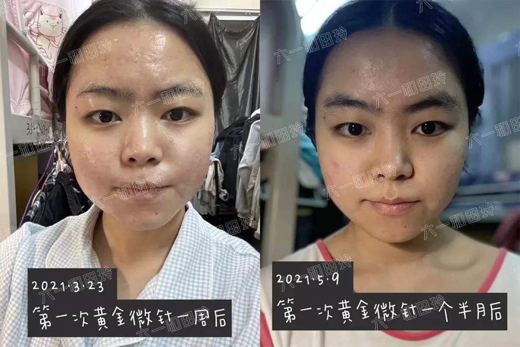 3250个文字很长，希望有痘坑的你看下去