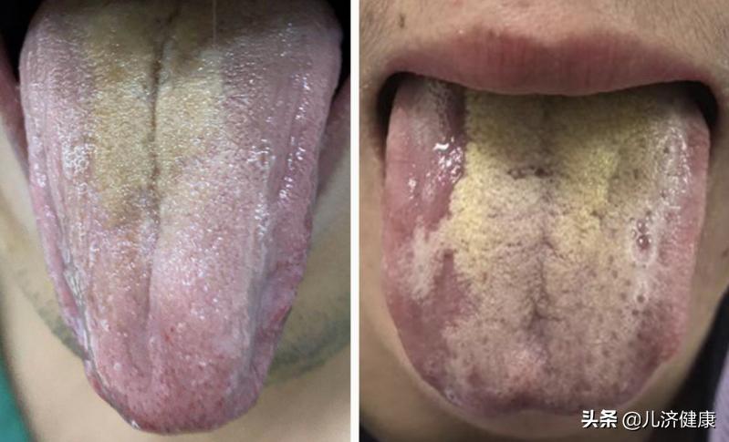 清热下火祛痘汤,清热解毒祛痘痘的汤