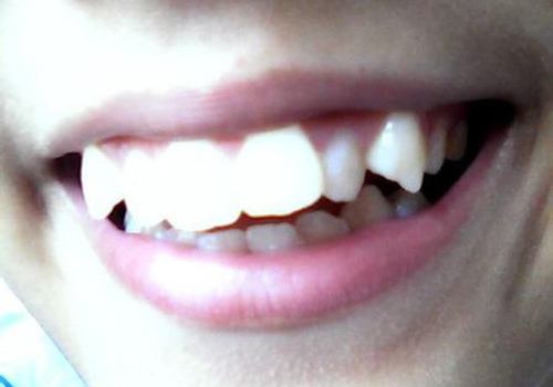 什么牙齿颜色是正常的,什么样的牙齿有特殊作用