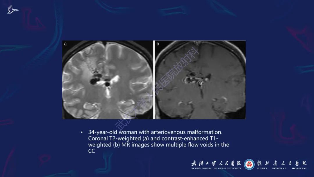 胼胝体肿瘤影像鉴别,胼胝体病变影像诊断