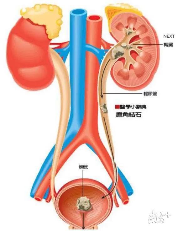 导致肾结石发病的诱因是什么,肾结石的症状怎么治疗
