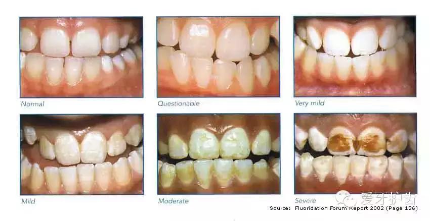为啥含氟的牙膏便宜,牙医让使用含氟牙膏