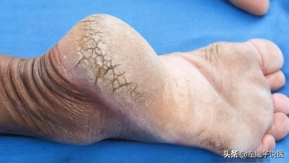 冬天脚后跟开裂起硬皮怎么办,一到冬天脚后跟裂口怎么回事