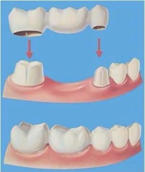 假牙与种植牙有什么利弊,老人假牙是种植牙好还是安假牙好