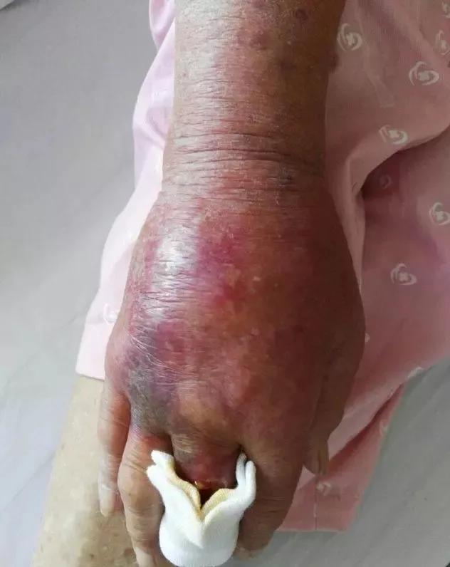 挤痘痘可引起败血症吗,挤痘痘引发的颅内感染能自己好吗