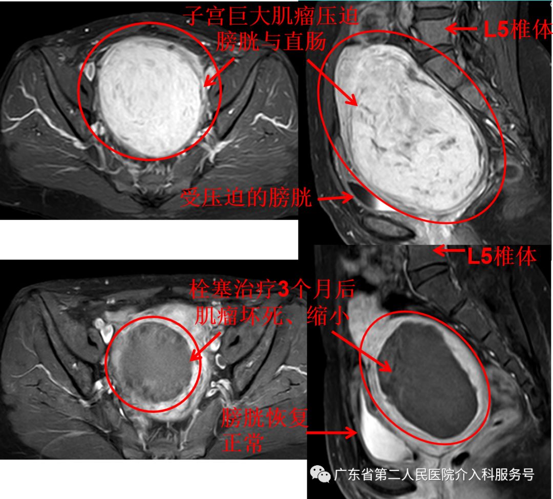 子宫肌瘤引起“大姨妈”排山倒海，淋沥不净……针眼妙方解除烦恼