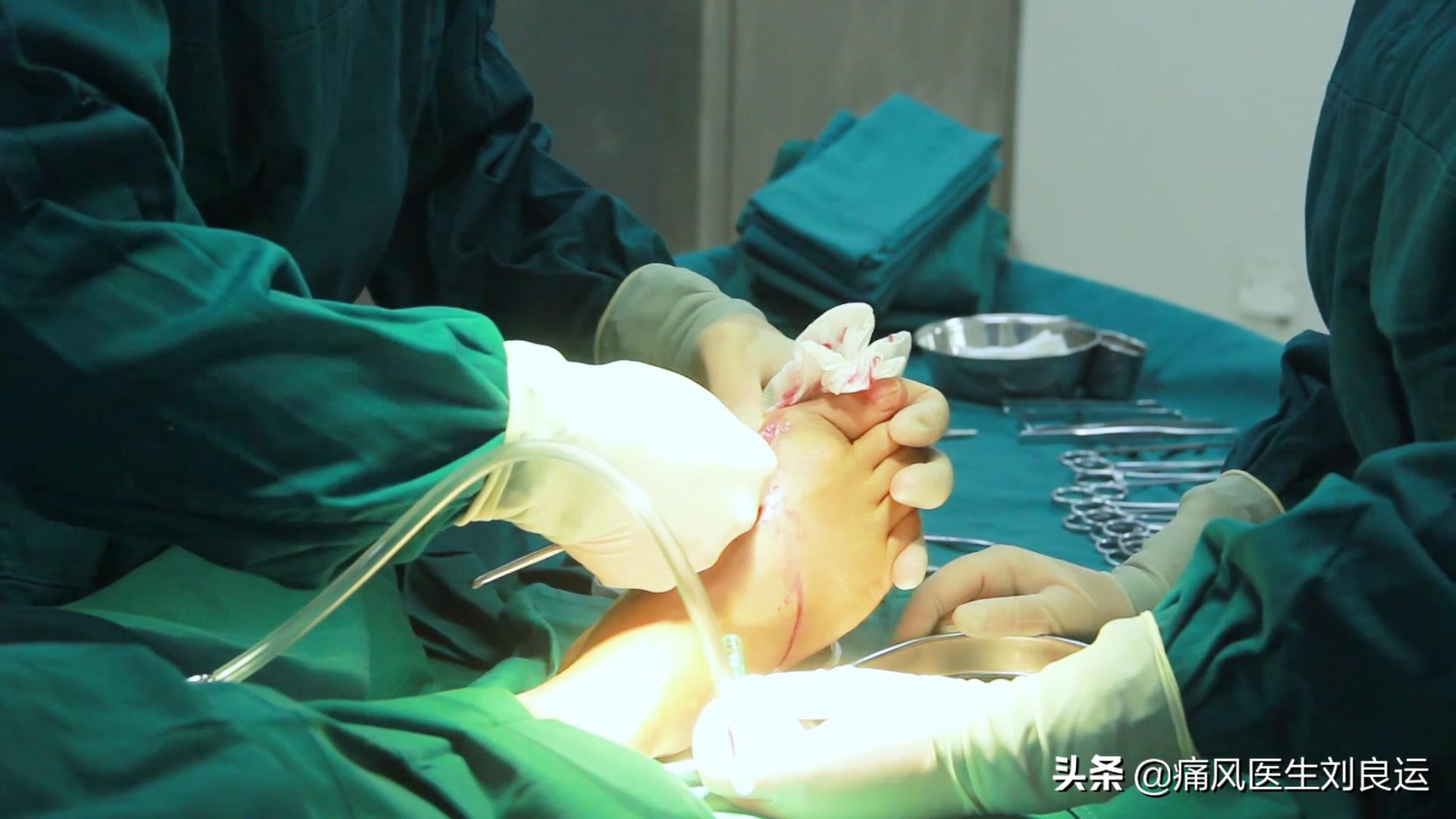 蜂针疗法可以治疗痛风吗,蜂疗灸可以治疗痛风吗