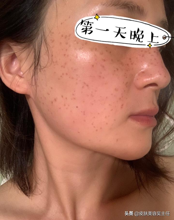 蜂巢皮秒英诺小棕瓶,脸上有斑的可以用英诺小棕瓶吗