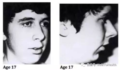 别让口呼吸毁掉你的颜值,脸毁了怎么补救