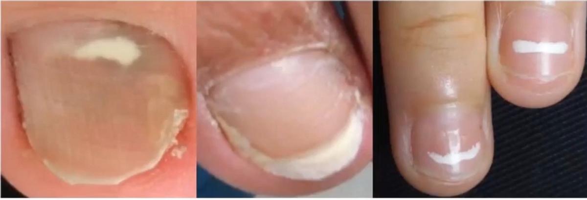 治灰指甲要验血吗,医院检查灰指甲挂号什么科