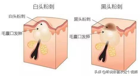 痘痘粉刺科普小知识,痘痘科普动画图
