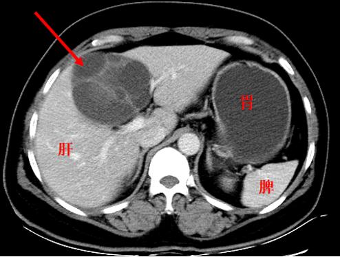 肠子摸上去有硬块就一定是肿瘤吗,乳腺有个鸡蛋大的硬块会是肿瘤吗