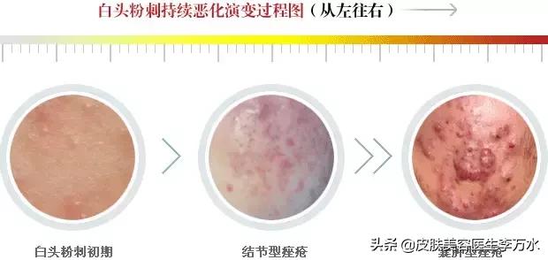 痘痘十大真相,痘痘大全图解