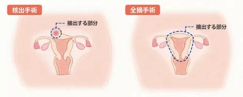 子宫肌瘤的10个前兆,子宫肌瘤有八个注意事项