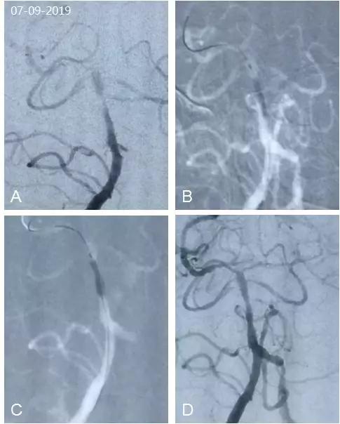 基底动脉狭窄介入指南,基底动脉重度狭窄用药用量