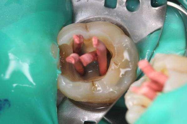 蛀牙不是病疼起来要人命,蛀牙只要不影响就可以不管