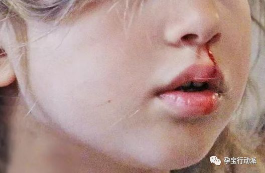 孩子经常流鼻血，不止是上火的原因