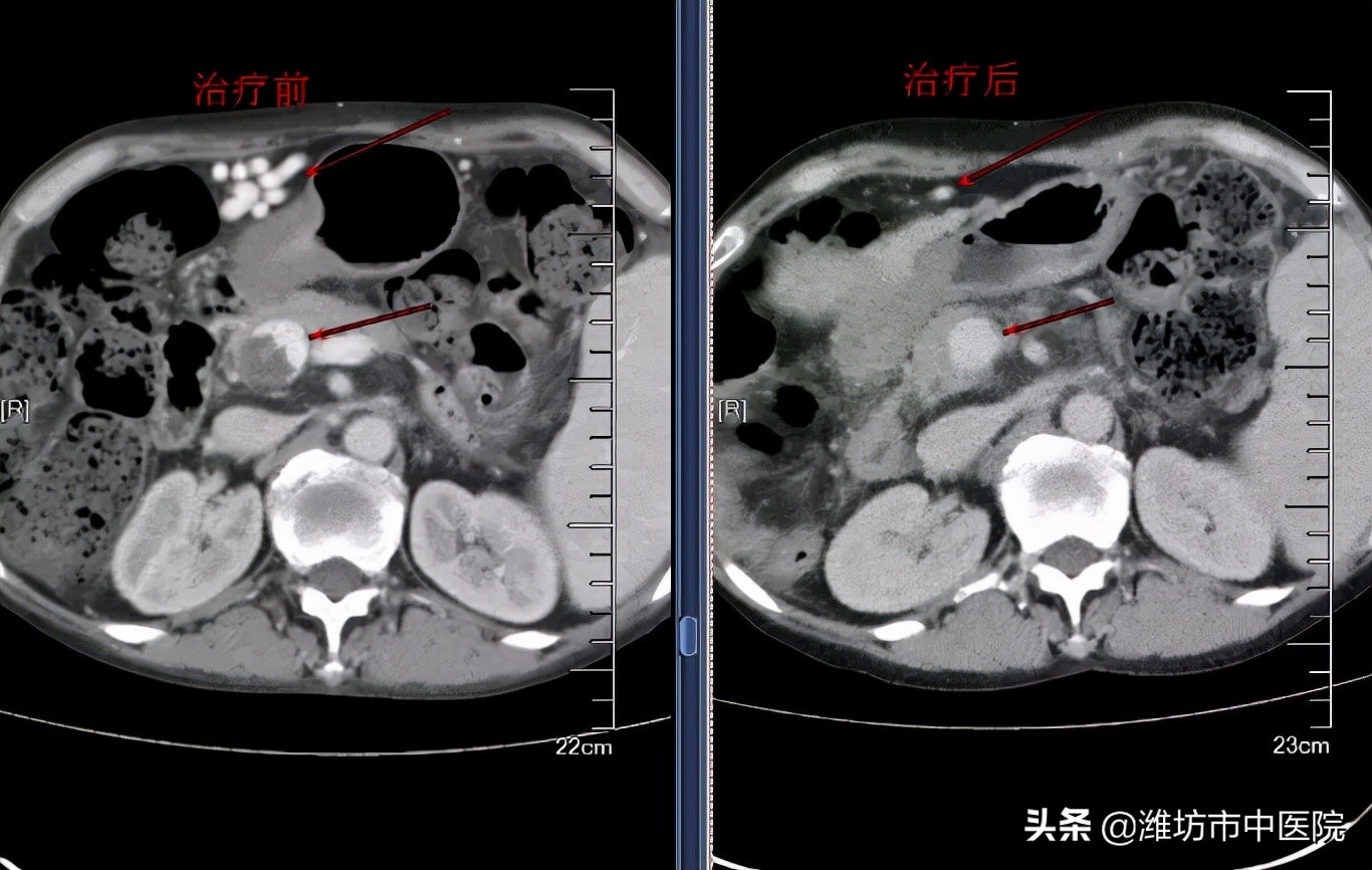 血瘀和血虚应该按哪个穴位,血瘀血虚同时存在先治哪个