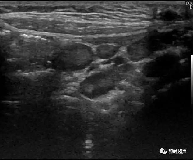 小儿消化道急症超声