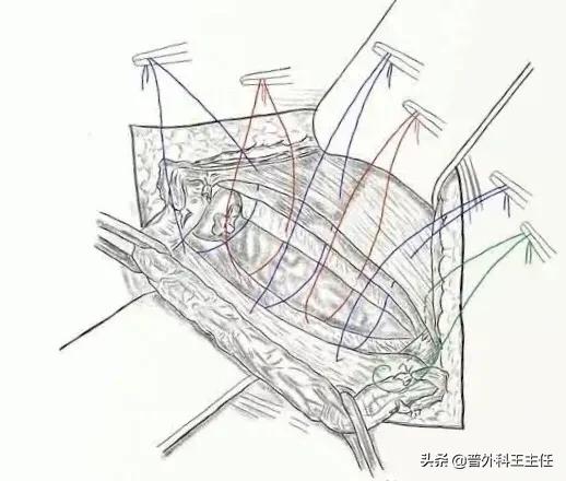 疝气注射疗法是治病还是致病？