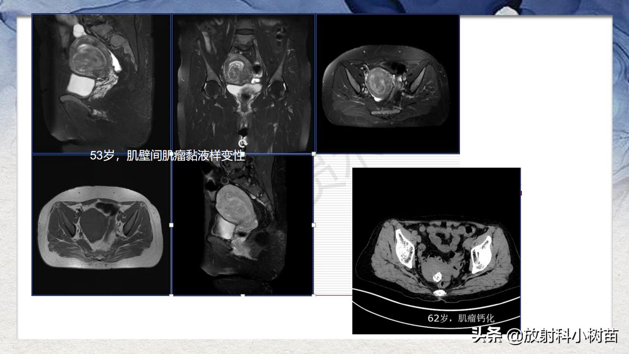 女性盆腔mri解剖图谱,泌尿生殖系统x线解剖