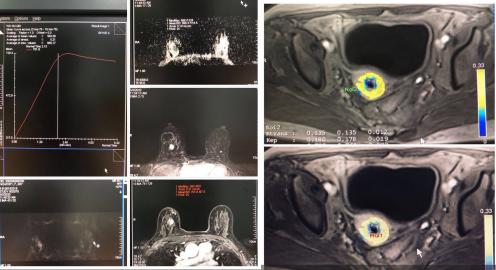 颅脑mr异常啥意思,颅脑mri未见明显异常说明什么