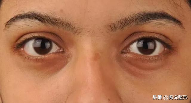 不熬夜黑眼圈还是去不掉是咋回事,很多年的黑眼圈了怎么才能淡化