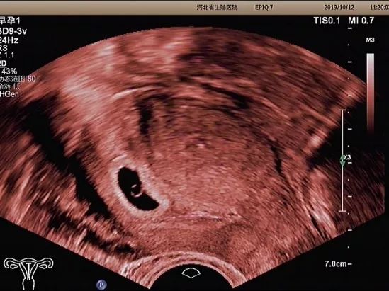 经阴道超声会不会伤害宝宝?看看专家怎么说