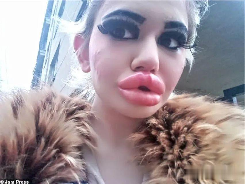 20次整容成功的女人,22岁女人做20次丰唇手术