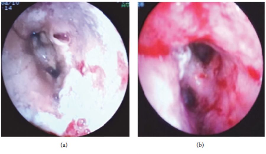 如何发现肺部真菌感染,怎样早期识别真菌感染