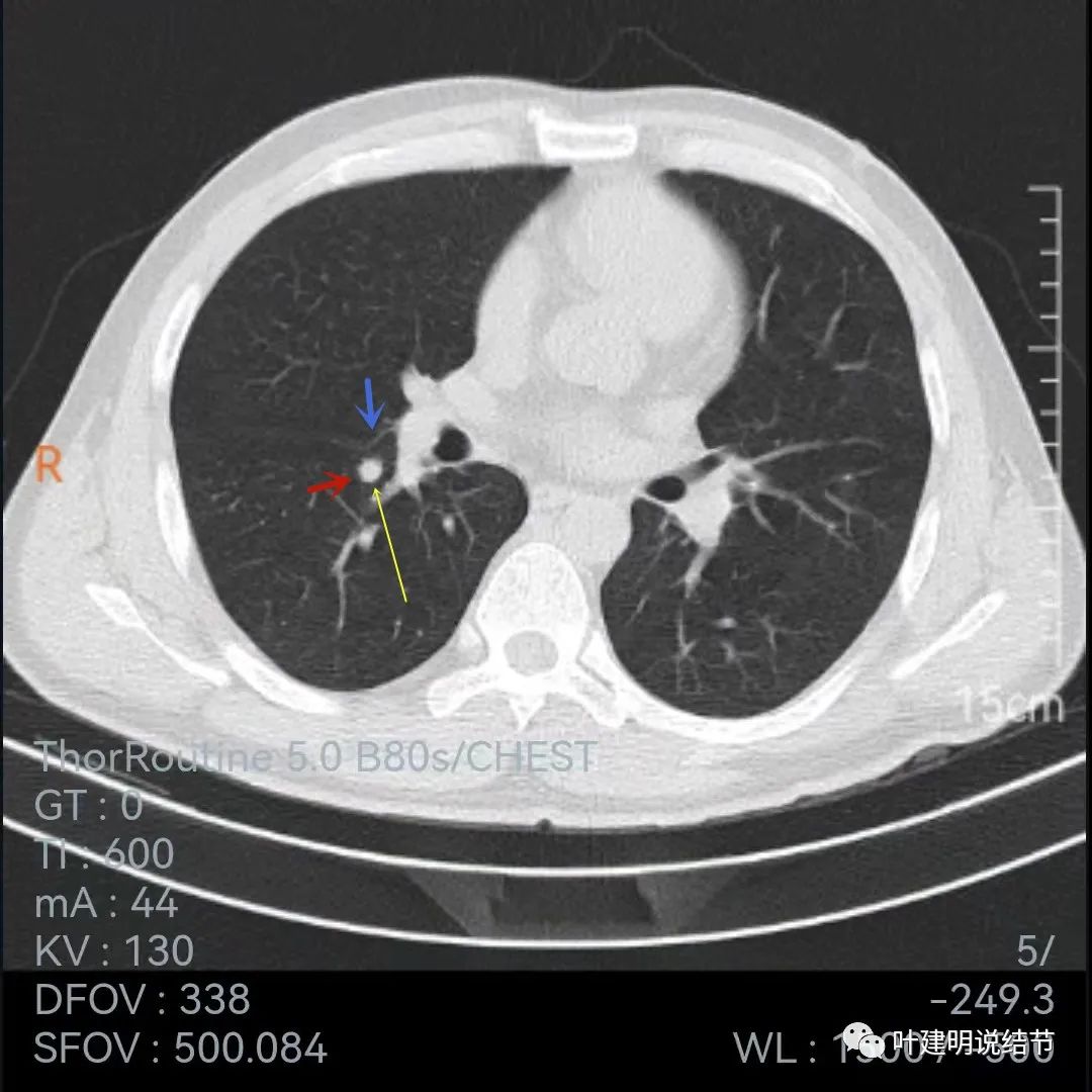 问诊分析:存在了4年的实性结节会不会是肺癌?