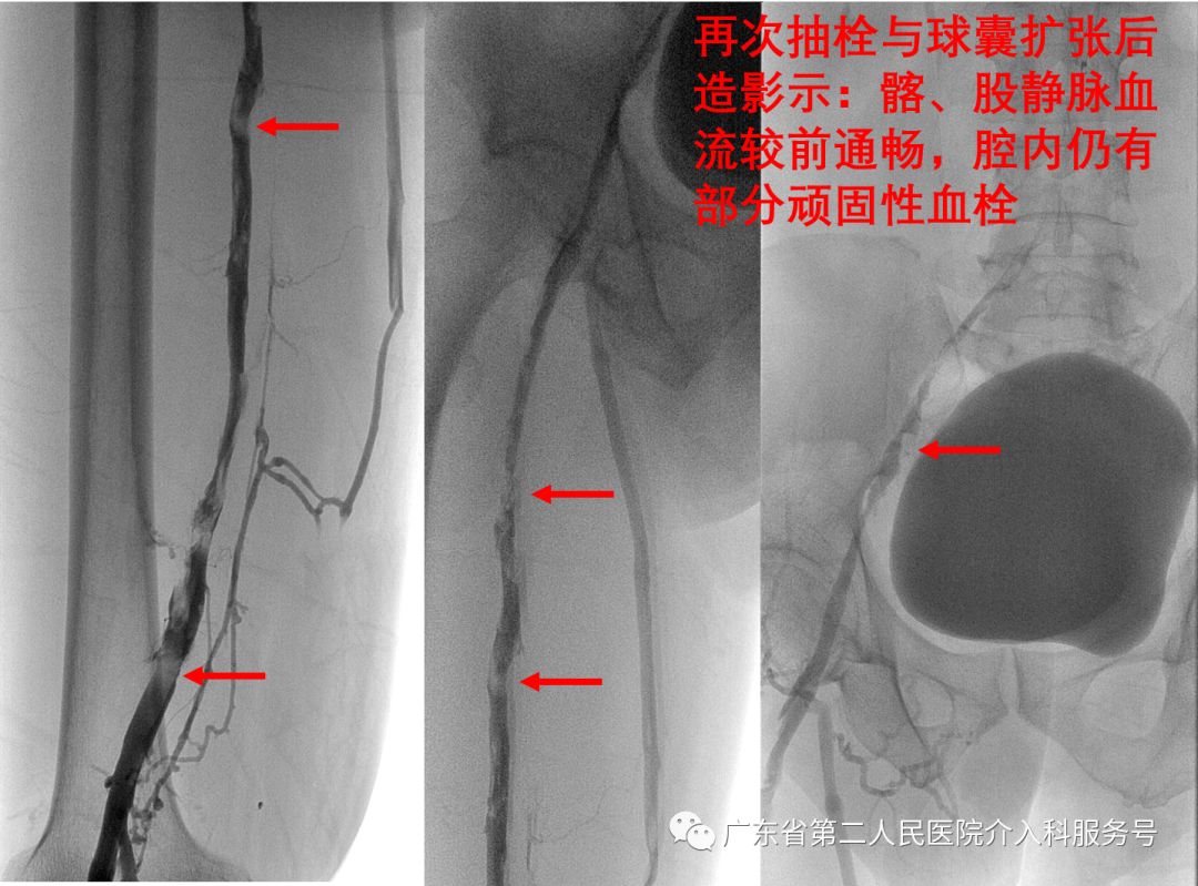 左腿血栓肿胀能完全恢复正常吗,左腿血栓肿痛怎么锻炼