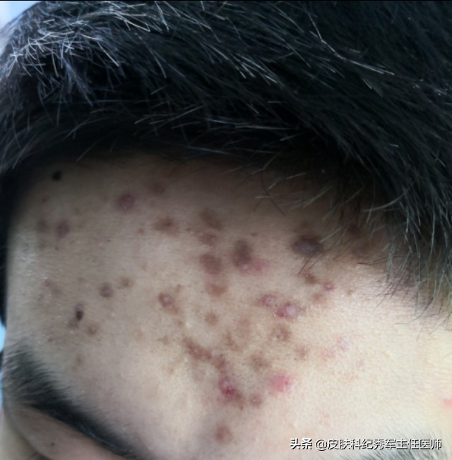 敏感肌红色痘印怎么去除,红色痘印色素沉淀怎么去除