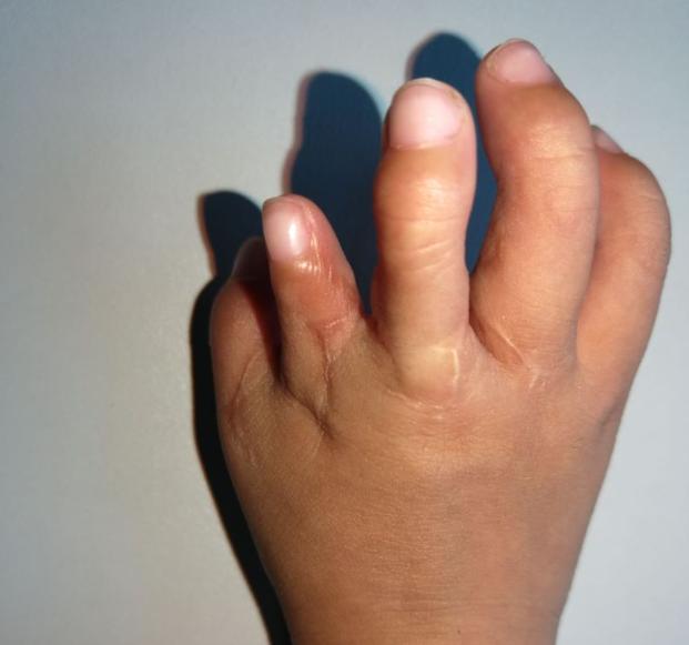 并指畸形免植皮案例,并指畸形