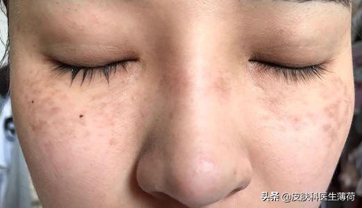 脸上激光了能喝中药吗,激光祛斑可以喝中药吗