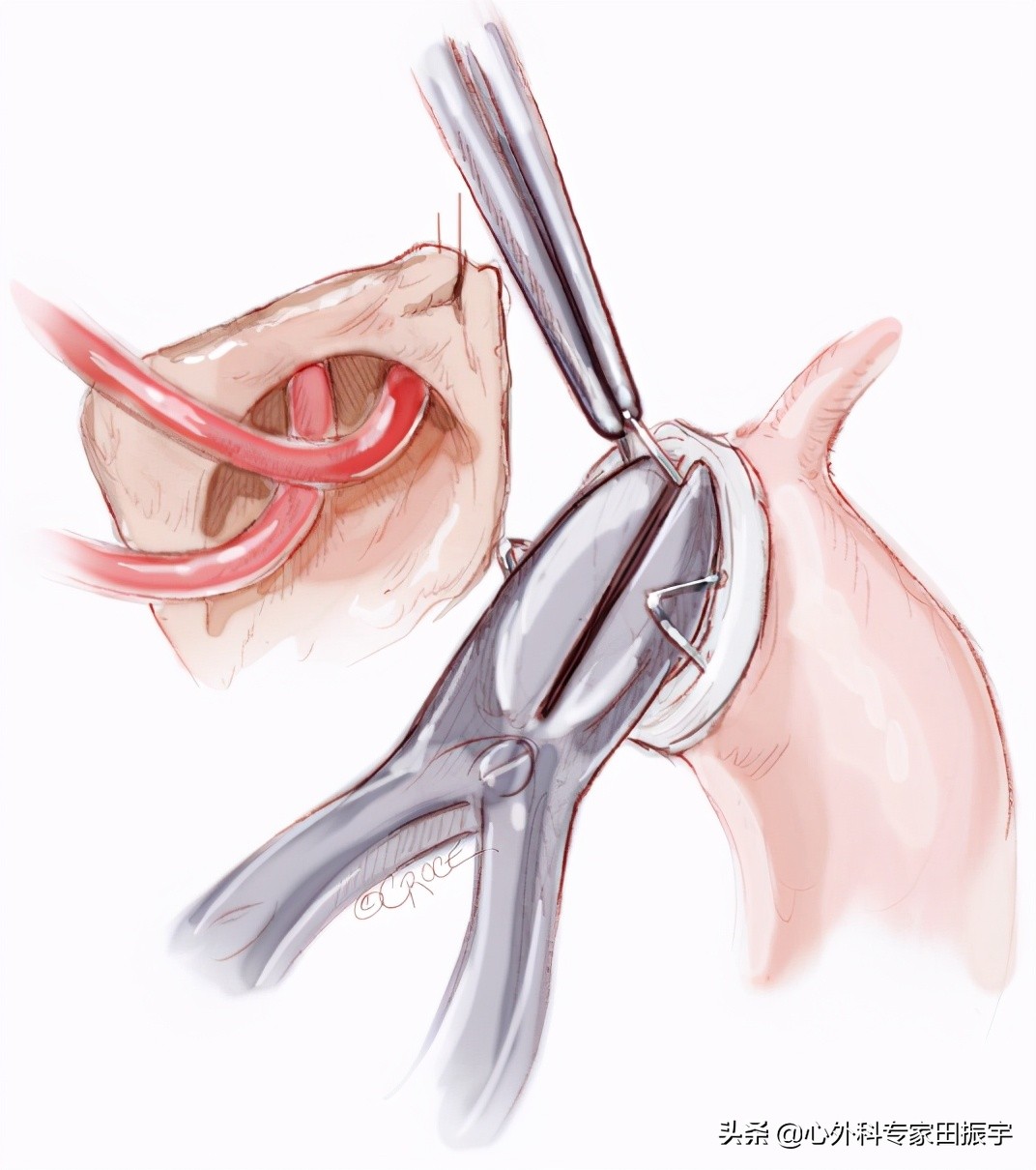 主动脉夹层破裂b型,急性主动脉夹层动脉瘤破裂