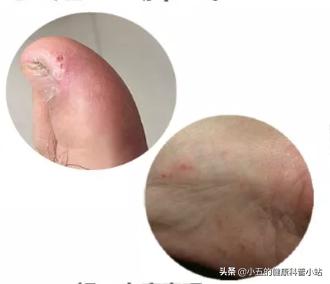 足癣瘙痒用什么药膏,脚丫溃烂水泡型足癣最怕的克星